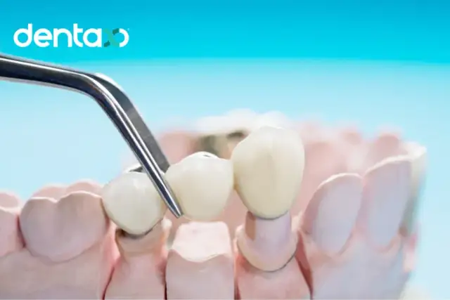 Mostek protetyczny: co to jest, rodzaje, koszt i czy warto?