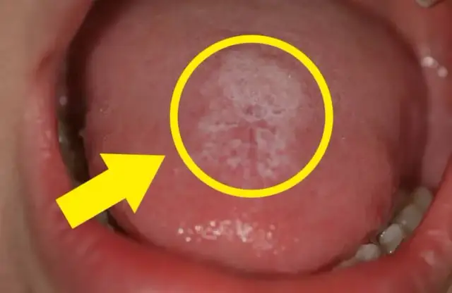 Drożdżyca jamy ustnej objawy – jak rozpoznać i co zrobić?