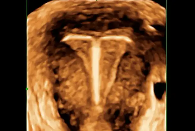 Przesunięcie wkładki domacicznej objawy – co powinno Cię zaniepokoić?