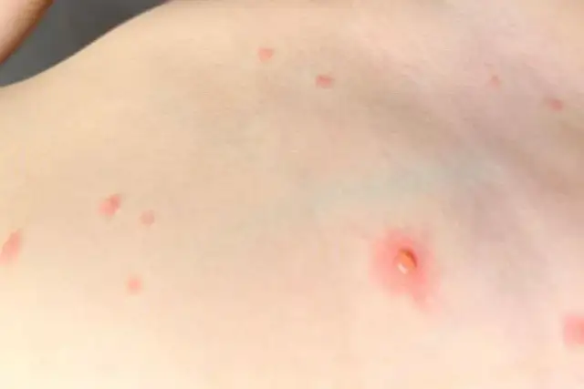 Ospa wietrzna: Skuteczne leki, pielęgnacja i czego unikać?