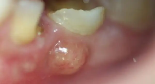 Ropa na dziąśle: Objawy, przyczyny i jak szybko ją wyleczyć