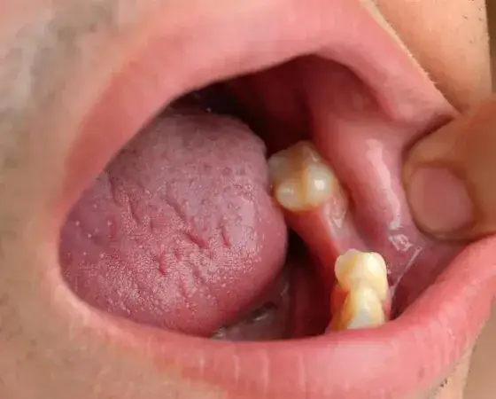 Biały nalot po wyrwaniu zęba: włóknik czy suchy zębodół?