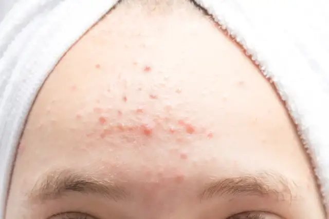 Pryszcze na czole: Skuteczne metody leczenia i zapobiegania