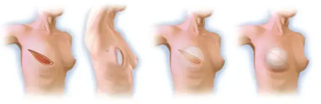 Mastektomia z rekonstrukcją NFZ gdzie znaleźć najlepsze ośrodki?