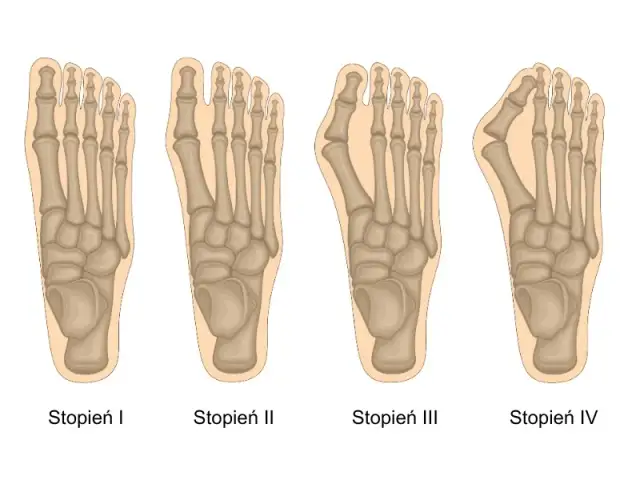 Haluksy: Jak rozpoznać paluch koślawy w domu?