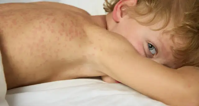 Skutki uboczne Vines: co musisz wiedzieć o działaniach niepożądanych