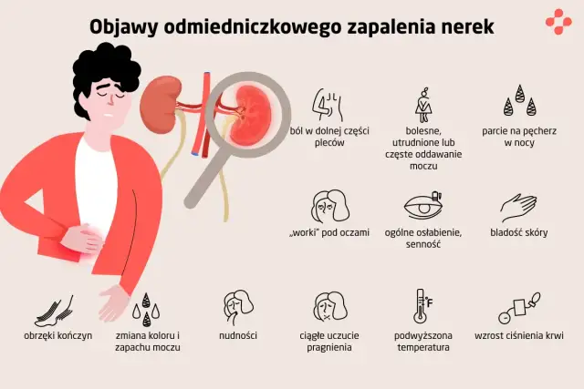 Objawy zapalenia nerek: Czy Twoje nerki wołają o pomoc?