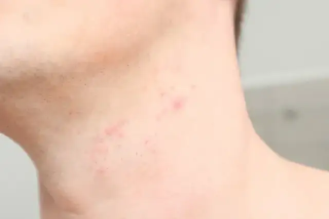 Jak złagodzić podrażnienia po goleniu? Gładka skóra bez krostek!