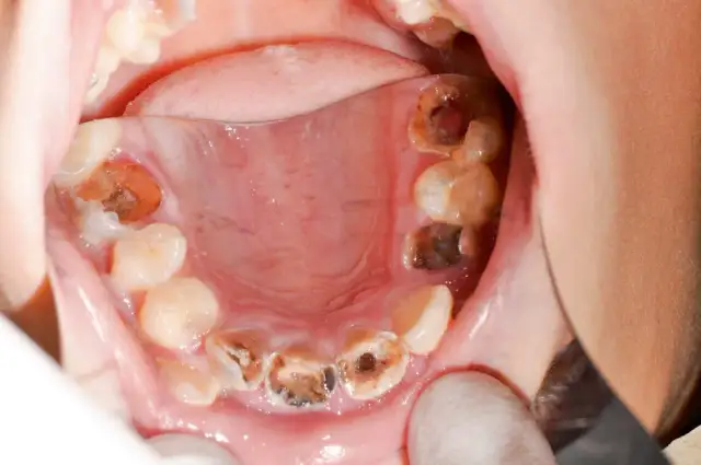 Otwarta przetoka po wyrwaniu zęba: objawy i leczenie