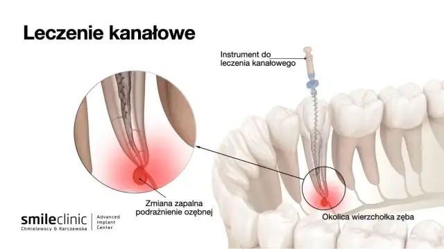 Leczenie kanałowe: Objawy, przyczyny i kiedy jest konieczne?