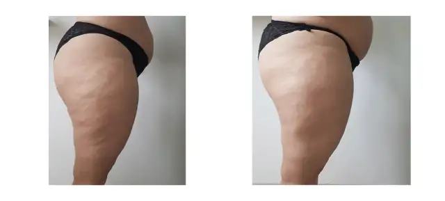 Endermologia Warszawa: Gdzie najlepiej i na co uważać?