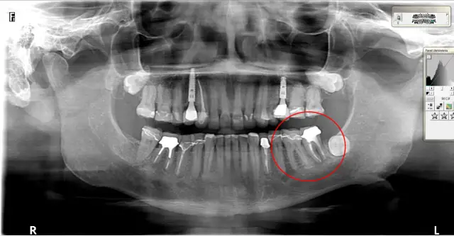 Pionowe pęknięcie korzenia zęba objawy – jak je rozpoznać i leczyć