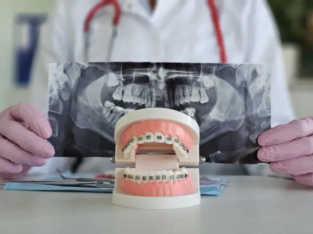 Kiedy założyć aparat na zęby? Nigdy nie jest za późno!