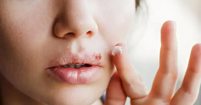 Opryszczka: Jak skutecznie zapobiegać nawrotom? Twój plan działania