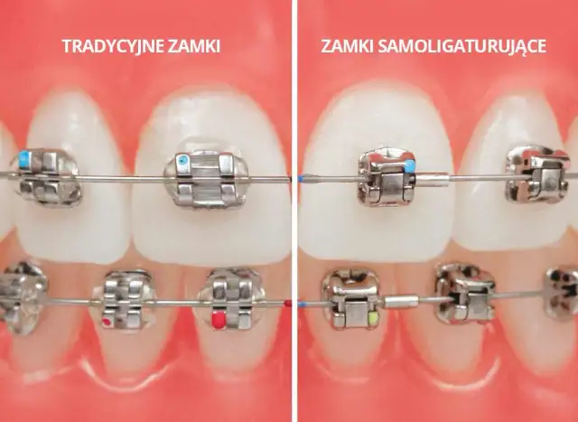 Ile trwa zakładanie aparatu na zęby? Czas wizyty i leczenia