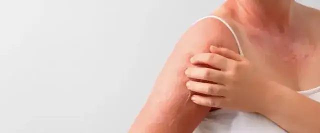 Skuteczne leki na alergię na słońce – ulga w objawach i ochrona