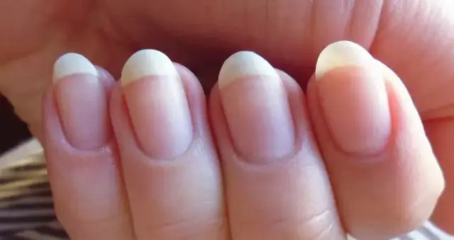 Wolny brzeg paznokcia – co to jest i dlaczego jest ważny dla zdrowia?