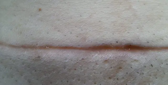 Kto ściąga szwy po porodzie? Dowiedz się, co warto wiedzieć o procesie.