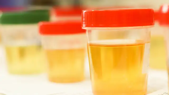 Opis próbki moczu: Co napisać na pojemniku? Uniknij błędów!