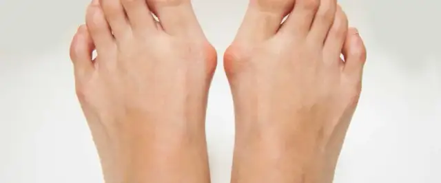 Od czego robią się haluksy? Genetyka, buty i nie tylko!