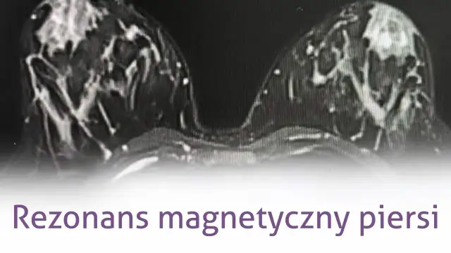 Mammografia czy rezonans - która metoda diagnozy raka piersi jest lepsza?