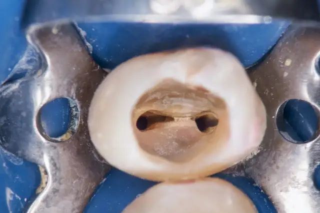 Widok wnętrza zęba z widocznymi kanałami, które mogą wskazywać na niedoleczony kanał zęba objawy. Metalowe klamry stomatologiczne otaczają ząb.