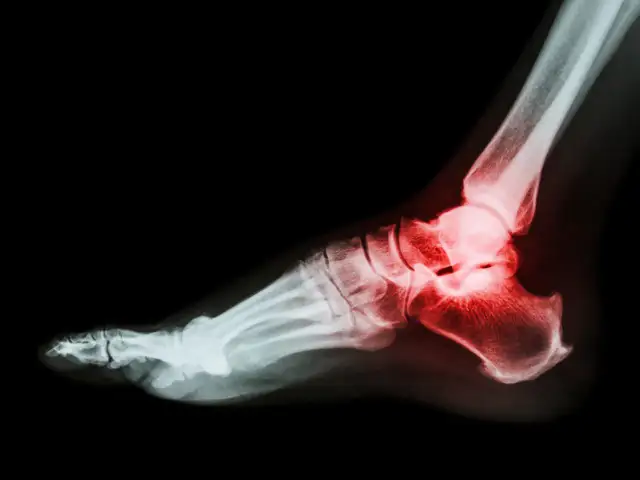 Złamana pięta: Jak długo trwa rehabilitacja? Poznaj realia
