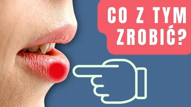 Opryszczka na ustach po makijażu permanentnym - skuteczne sposoby leczenia