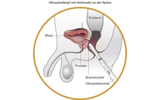 Prostata-Vorsorge ab 30: Wann ist sie wirklich nötig?