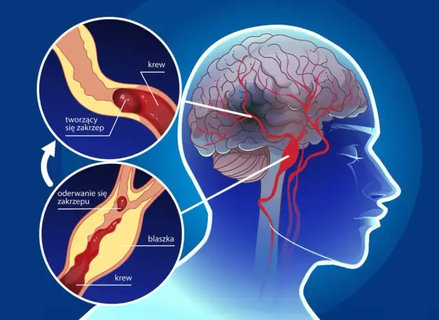 PFO objawy neurologiczne: Jak unikać ryzyka udaru mózgu?