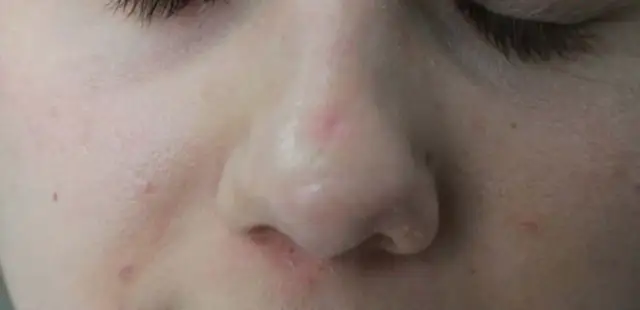 Jak szybko pozbyć się strupa po pryszczu i uniknąć blizn