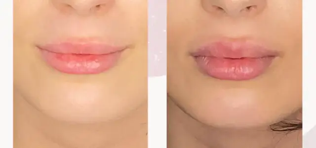Powiększanie ust kwasem hialuronowym: Cennik i ukryte koszty