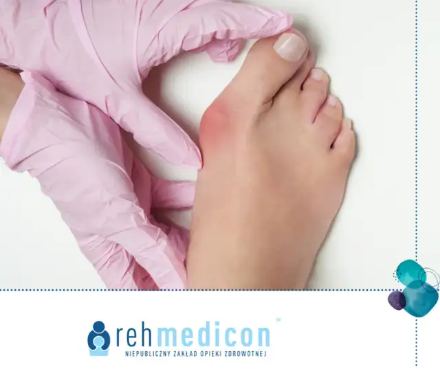 Skuteczne sposoby na haluksy: co stosować, aby złagodzić ból