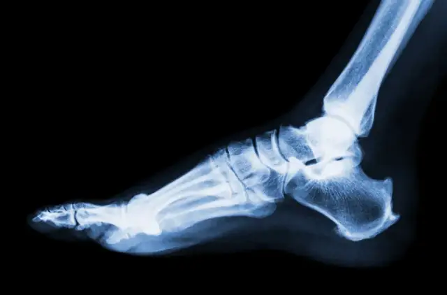 Ile trwa leczenie skręconej kostki? Sprawdź czas gojenia