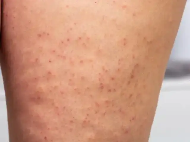 Eingewachsenes Haar am Bein: Ursachen, Behandlung und Vorbeugung