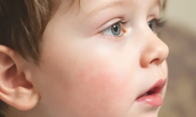 Rumień zakaźny: kiedy bezpiecznie wrócić do przedszkola?