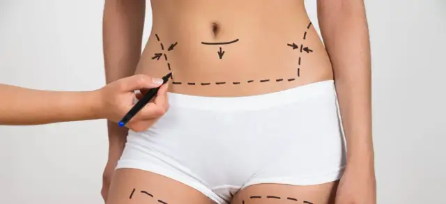 Liposukcja kawitacyjna - kiedy zobaczysz efekty zabiegu?