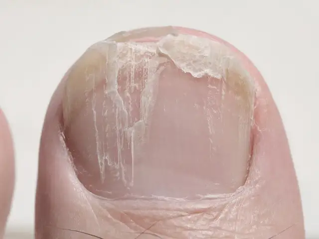 Pionowe bruzdy na paznokciach: Naturalny objaw czy choroba?