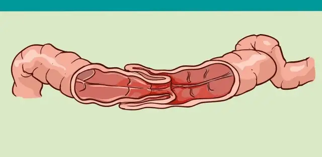 Wgłobienie jelita u niemowlaka objawy – jak je rozpoznać i reagować