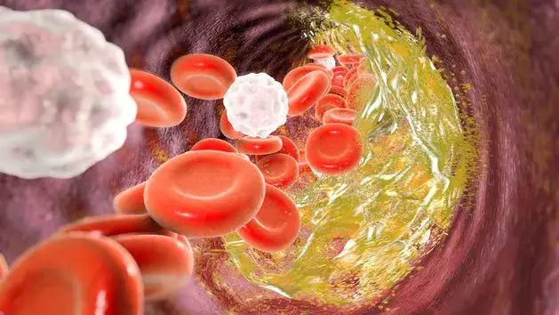 Czy cholesterol 250 to dużo? Normy, zagrożenia i jak go obniżyć