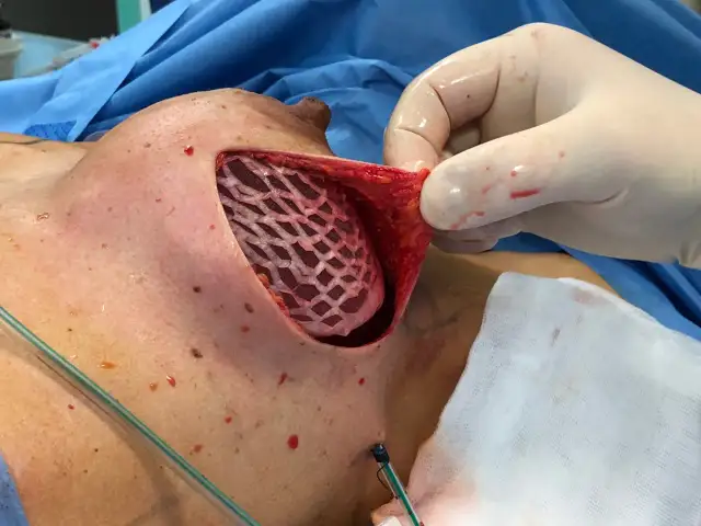 Mastektomia z rekonstrukcją nfz gdzie - najlepsze ośrodki w Polsce