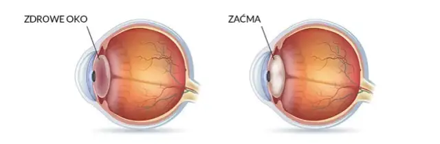 Czym jest zaćma wtórna? Objawy, przyczyny i metody leczenia