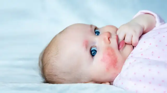 Wysypka u niemowlaka: Skaza białkowa czy potówki? Kluczowe różnice