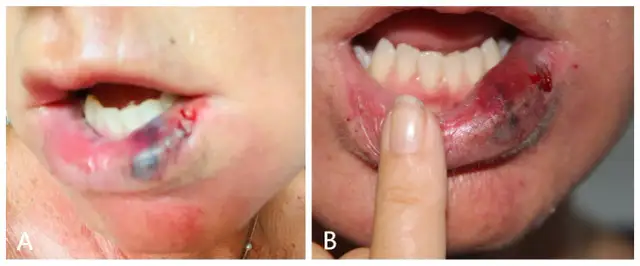 Labios deformados por ácido hialurónico: causas, consecuencias y soluciones