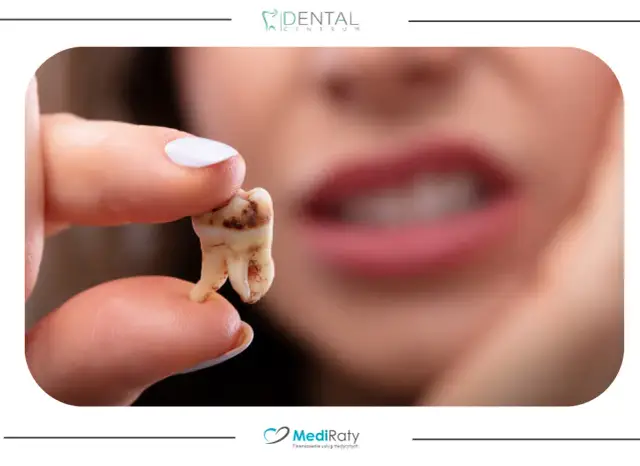 Kiedy wyrwać ząb? Objawy, wskazania i alternatywy leczenia