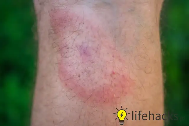 Kleszcze pod skórą? Fakty, usuwanie i objawy chorób