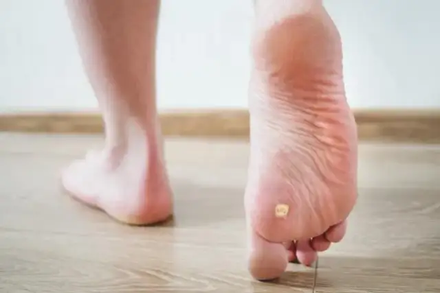 Skuteczne sposoby na pozbycie się odciska na stopie bez bólu