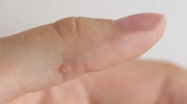 Jakiego lekarza wybrać na kurzajki, aby skutecznie je wyleczyć?