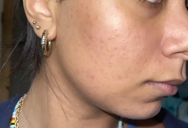 Skóra twarzy z niedoskonałościami, widoczne zaczerwienienia i drobne krostki. Może to być etap przed zastosowaniem spirytusu salicylowego na twarz.