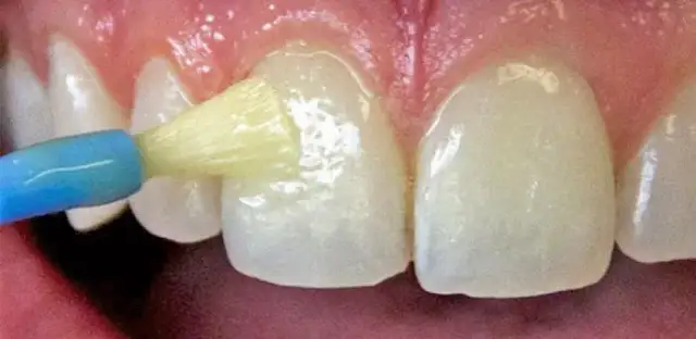 Czy fluoryzacja wybiela zęby? Odkryj prawdę o jej działaniu